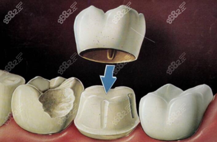 单颗牙冠下的修复