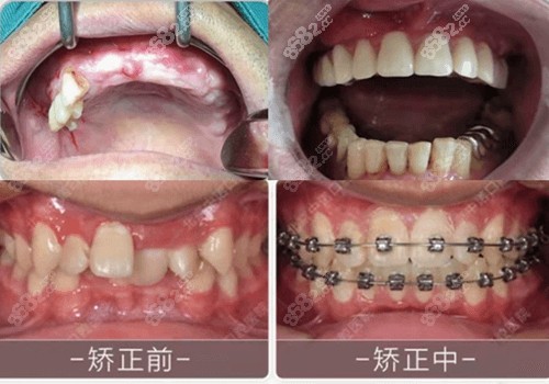 北京中诺口腔整牙种植牙对比照