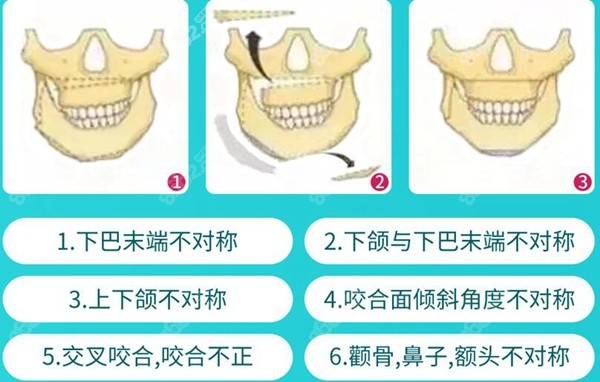 面部常见的磨骨手术部位