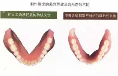 吸附性义齿与普通义齿的区别