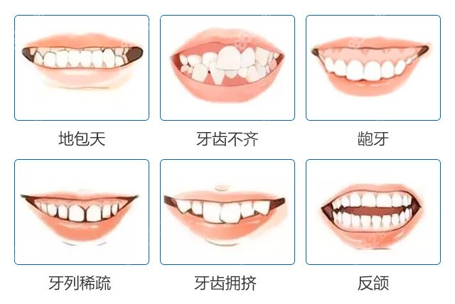成年人牙齿矫正拔4颗牙收缝要多长时间