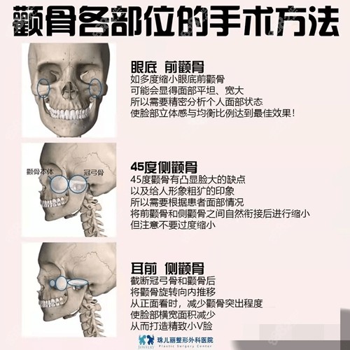 颧骨整形改善方法