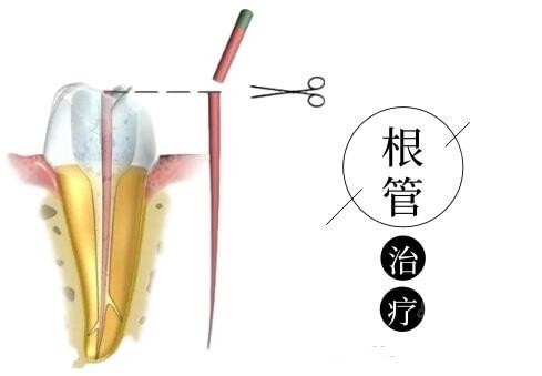 做完根管治療后牙齒還能堅持多久