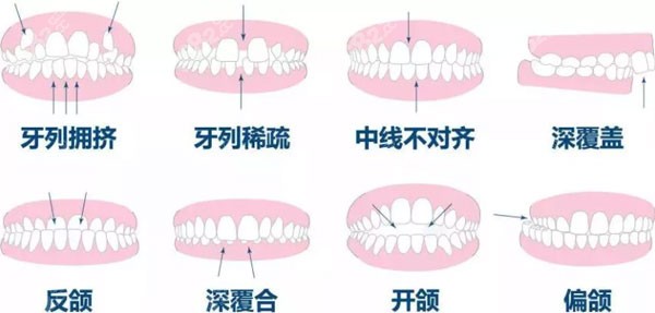 金属矫正器和自锁牙套