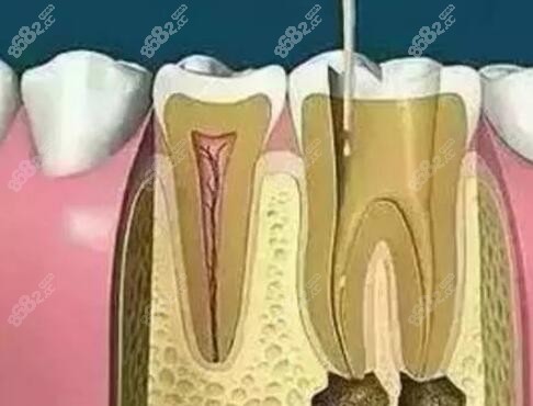 牙齒根管治療疼嗎