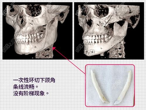 韩国女神整形外科下颌角手术优势
