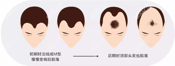 m脱的程度
