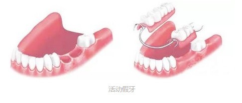 活动假牙
