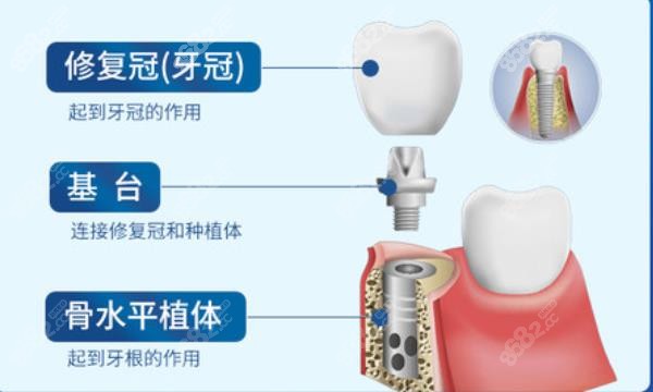 天津美奥口腔做种植牙怎么样