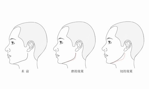 国内做下颌角好的医生排名