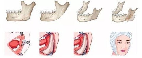 下巴截骨术图片