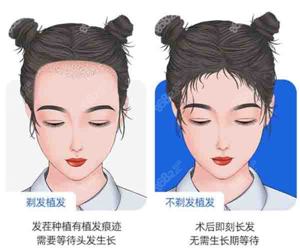 不剃发技术的优点