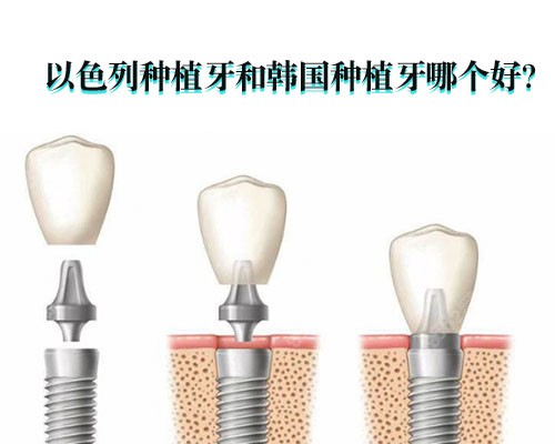 以色列种植牙和韩国种植牙哪个好