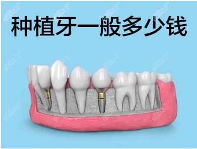 老年人全口种植牙价格表
