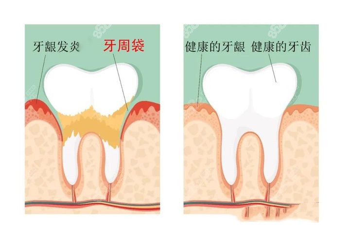 这是牙根发炎的前后对比图