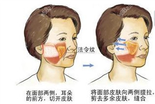 穆宝安院长V美减龄技术