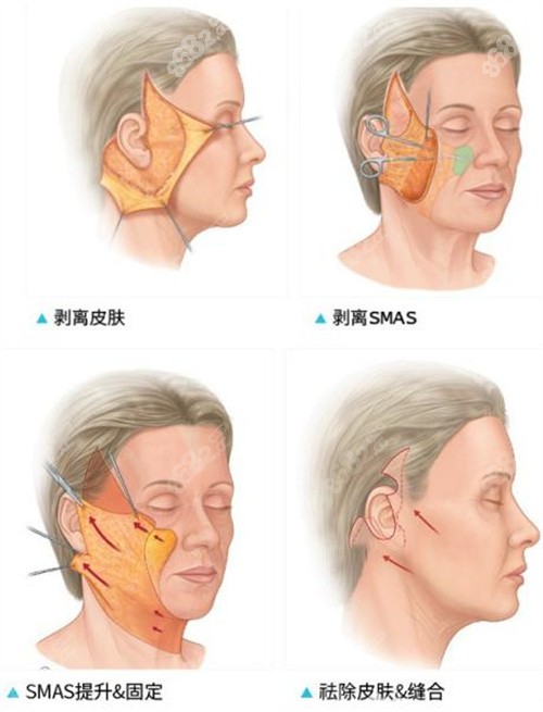 小切口面部提升图