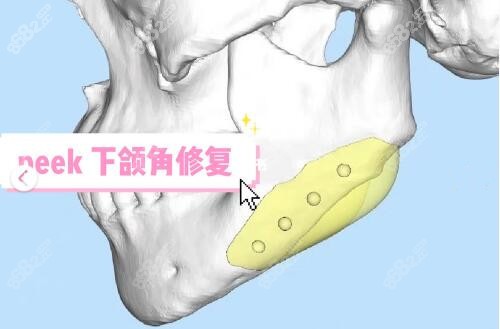 3d打印人工骨技术修复下颌角切多了缺损补骨