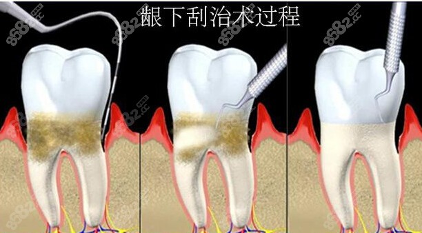 龈下刮治的过程