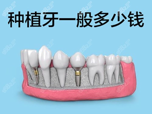 韩国种植牙多少钱一颗