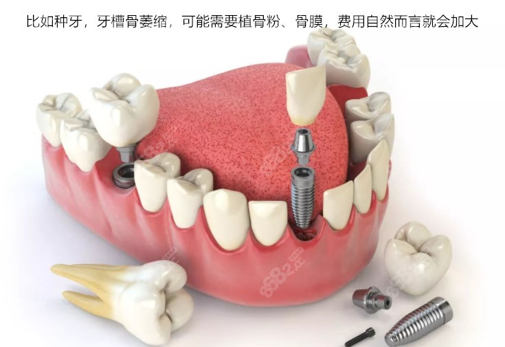 种植牙收费价格