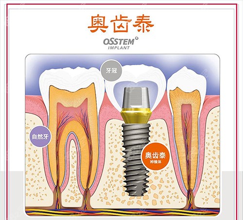 韩国奥齿泰osstem 种植体