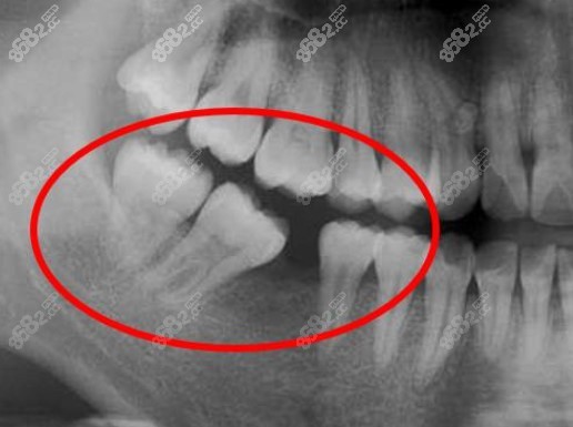 牙齿长时间缺失，临牙倾斜，牙槽骨有一定程度吸收
