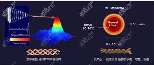 半岛超声炮的优势大聚焦技术