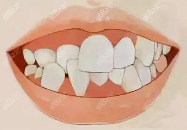 牙齿不齐有没有必要做矫正