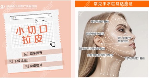 杭州连天美整形医院小切口拉皮