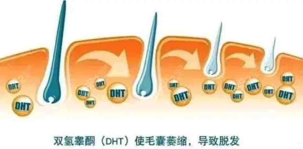 脂溢性脱发原理图