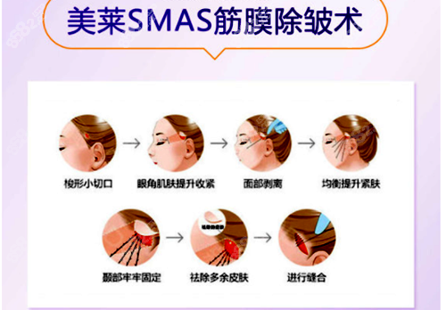 武汉美莱医疗美容医院SMAS拉皮除皱术