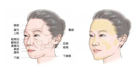 脂肪填充和拉皮手术可以同时操作吗？