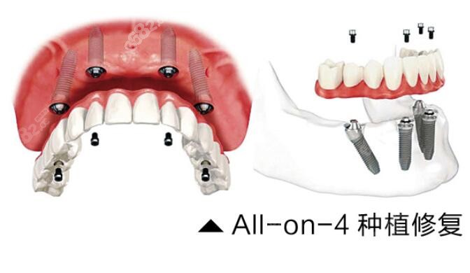 ALL-ON-4种植牙