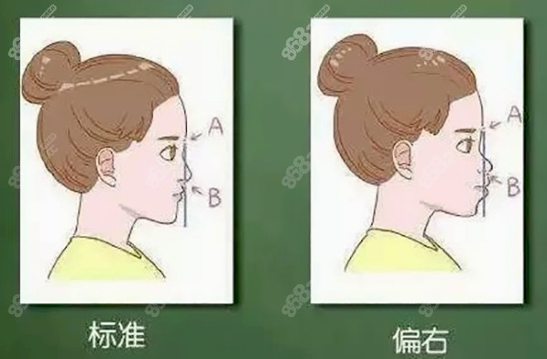 先瞧怎样分辨凸嘴是不是骨性的