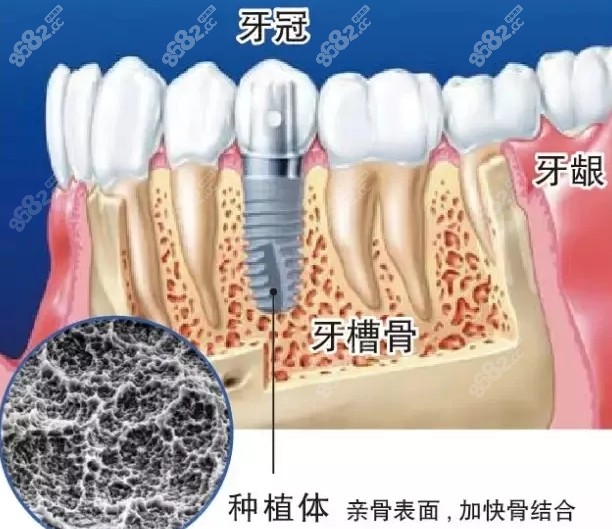 种植体亲骨表面的图