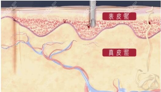 植发针头破皮过程