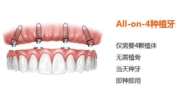 all-on-4全口种植牙