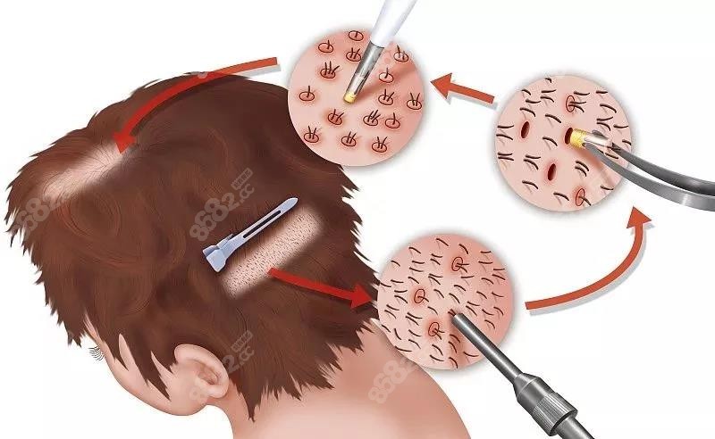 植发的原理取后枕部毛发