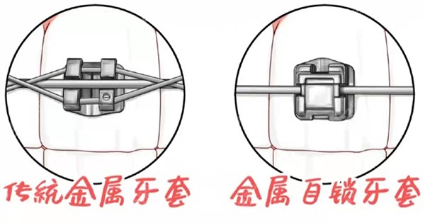 矫正的价格与牙齿矫正器的选择有关传统金属,金属自锁,陶瓷自锁,刹噜