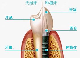 种植牙组成部分图