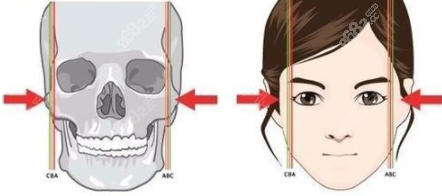 颧骨内推矫正颧骨一高一低脸歪图示