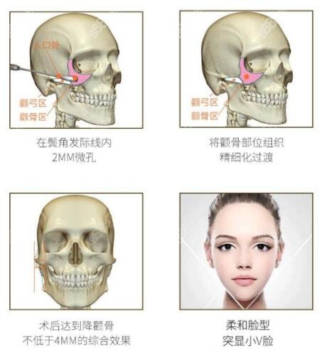 微创一针降颧骨原理