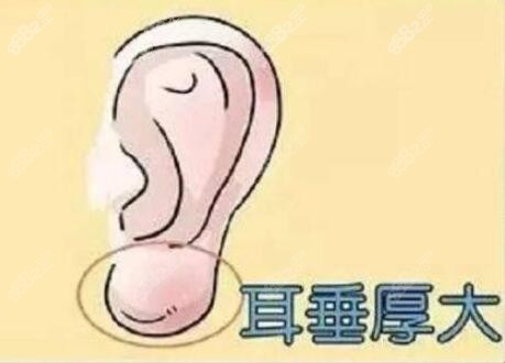 耳垂过大可以缩小吗