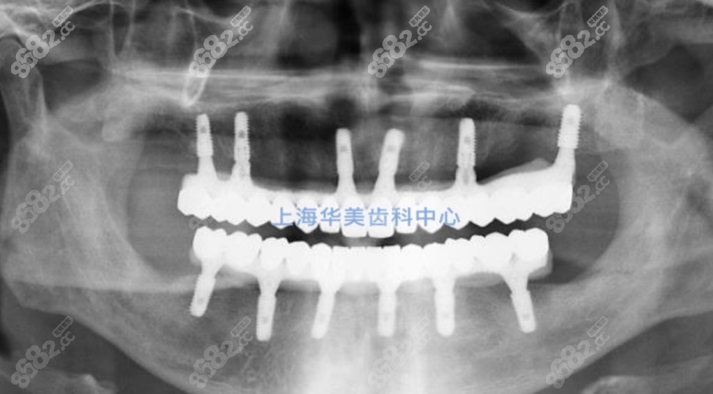 上海华美齿科全口种植牙