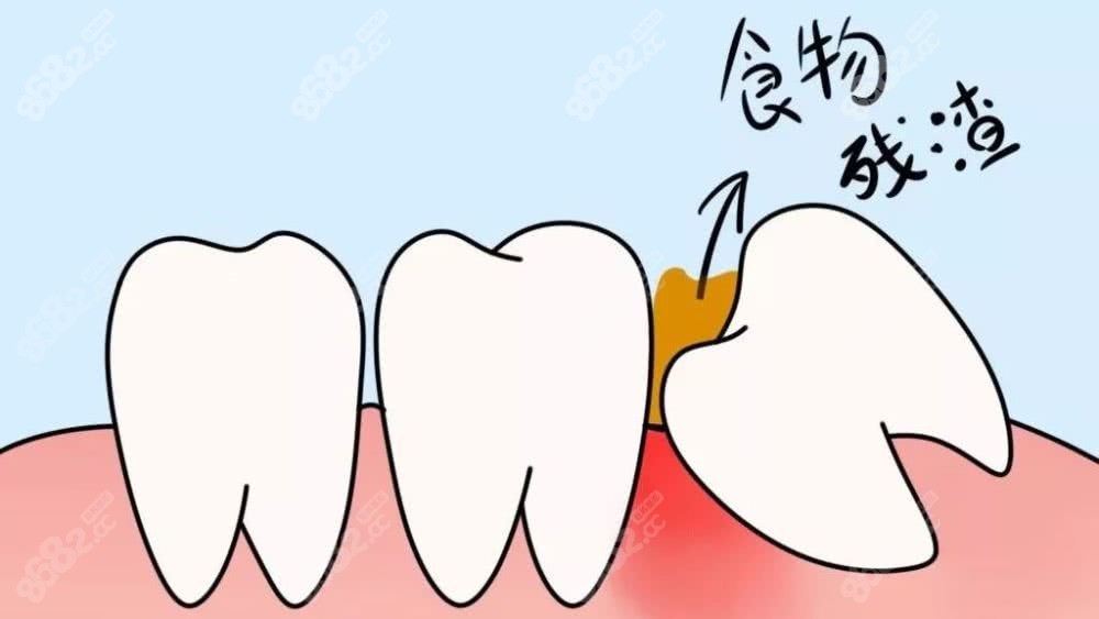 智齿会形成蛀牙的图