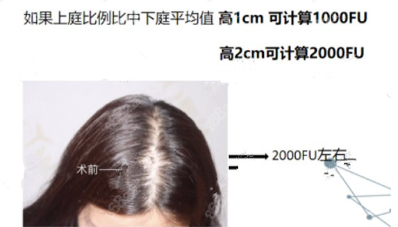 发际线后移一厘米需要多少毛囊