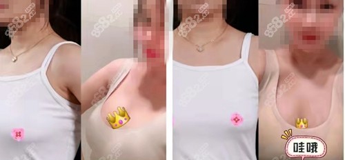 长沙美莱隆胸前后对比照