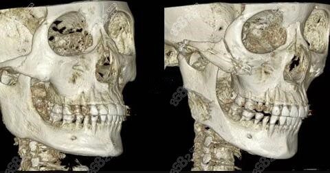 颧骨内推ct图片