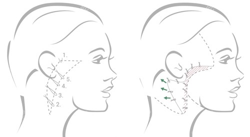 面部拉皮提升部位